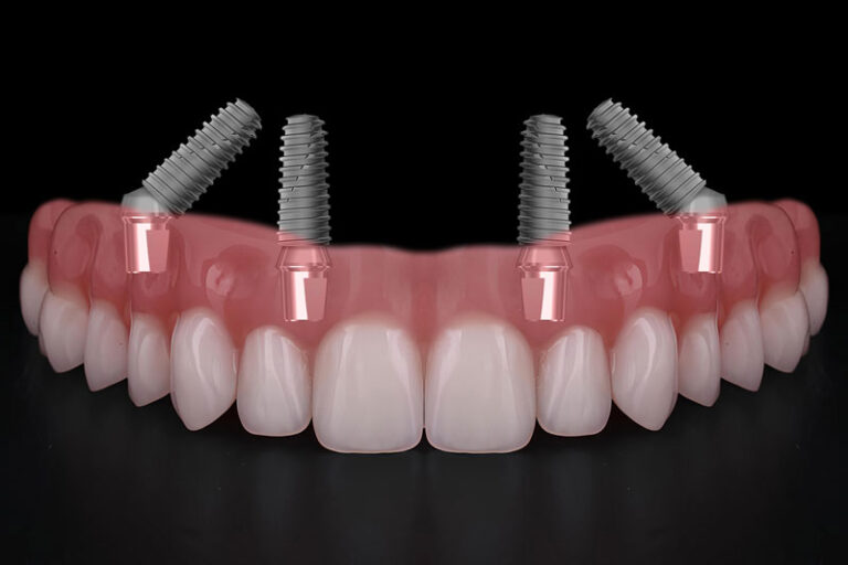 all on 4 dental implants with a full arch going across it