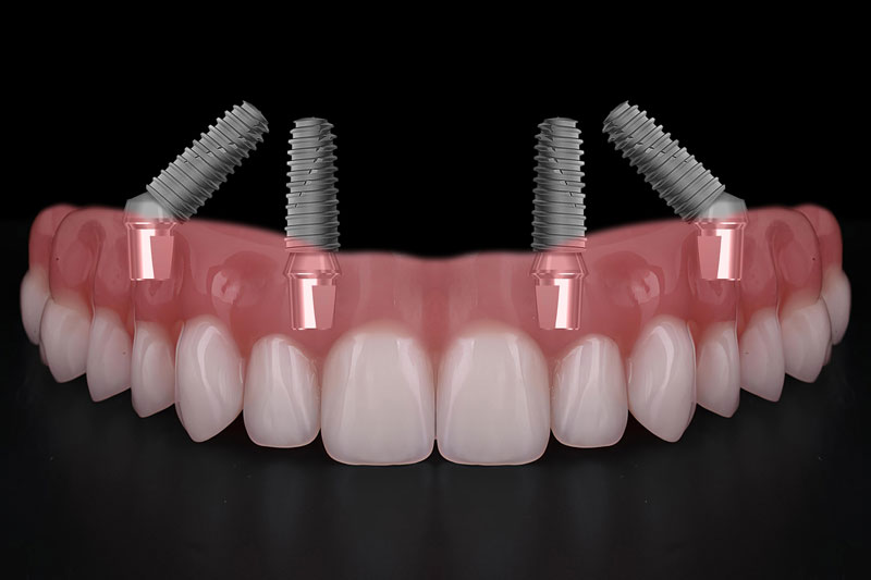all on 4 dental implants with a full arch going across it