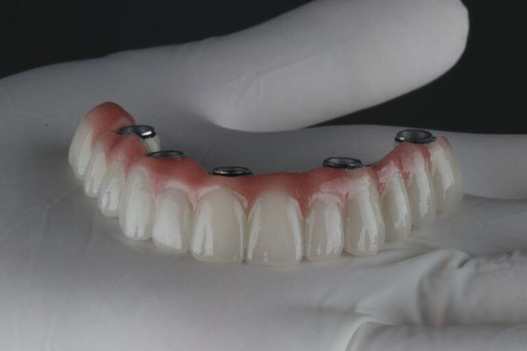 a full arch of teeth with holes for implants to be placed into the jaw